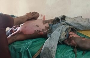 कोयला निकालने के दौरान हाई वोल्टेज तार की चपेट में आया मजदूर, 70% झुलसा – हालत गंभीर