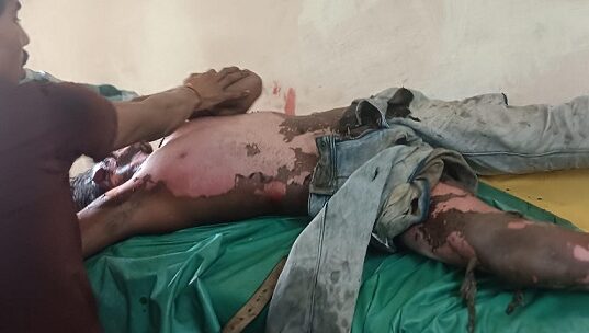 कोयला निकालने के दौरान हाई वोल्टेज तार की चपेट में आया मजदूर, 70% झुलसा – हालत गंभीर